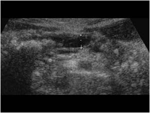 january 2002 - Dilatation of the pancreatic duct with calculi