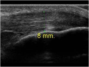Tendinosis of the distal patellar tendon longitudinal