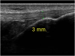 Normal distal patellar tendon longitudinal