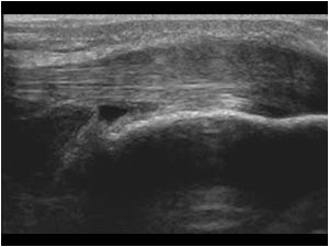 Tendinosis of the distal patellar tendon longitudinal