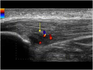 Central area of tendinosis on the right side longitudinal