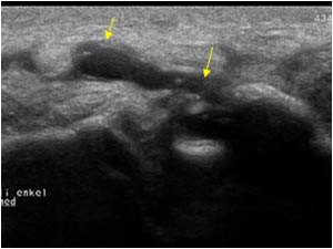 Ganglion cyst with connection to the joint space longitudinal