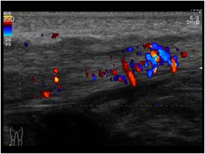 Peroneal tendons with hypervascularity longitudinal