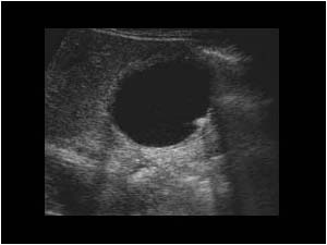 january 2003 - Calcifications in the cyst