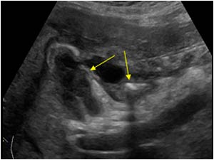 Gallbladderwall defect and stone outside the gallbladder