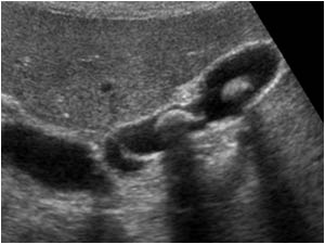 Perforation in the gallbladder wall