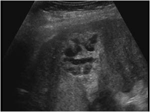 Pericholecystitis with irregular fluid collection outside the gallbladder transverse