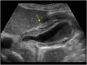 Edematous thickening of the gallbladder wall longitudinal