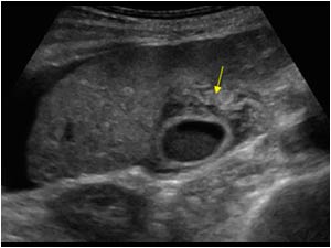 Edematous thickening of the gallbladder wall transverse