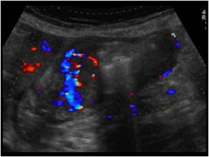 Massively thickened and vascularized gastric wall longitudinal