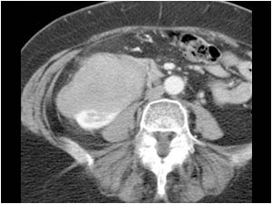 Gastrointestinal stromal tumor