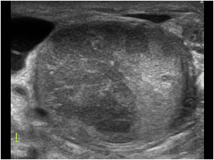 Swollen inhomogeneous hypoechoic testicle