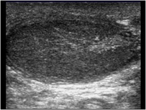 Beginning atrophy of the testicle longitudinal