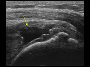 Large full thickness supraspinatus tendon rupture longitudinal