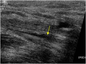 Longitudinal intratendinous distal biceps tendon rupture longitudinal