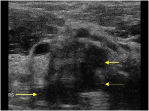 Thickened distal biceps tendon and effusion in the bicipitoradial bursa transverse