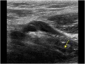 Intratendinous tendon rupture and effusion in the bicipitoradial bursa longitudinal