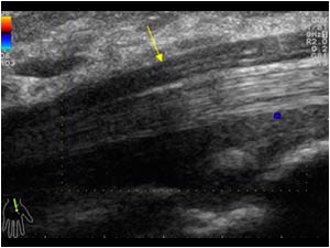 No perineural hypervascularity  on the normal side
