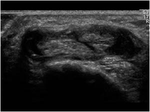 Tenosynovitis of the tendons of the first and second extensor tendon compartment transverse