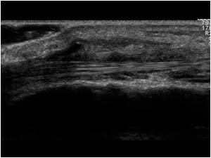 Tenosynovitis of the tendons of the first and second extensor tendon compartment longitudinal