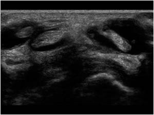 Effusion in the tendon sheaths of the extensor tendons of compartment 2 and 3 transverse