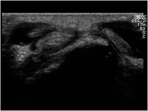 Effusion in the tendon sheaths of the extensor tendons of compartment 2 and 3 transverse