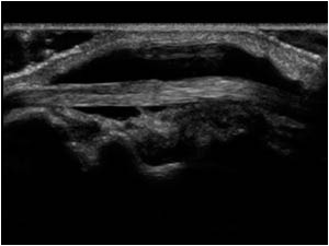 Effusion in the tendon sheath of the extensor pollicis longus tendon longitudinal