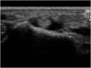 Effusion in the tendon sheath of the extensor pollicis longus tendon next to Listers tubercle