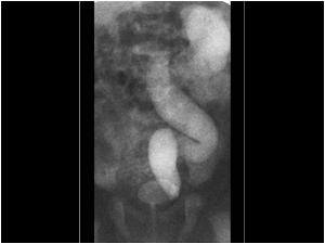 Posterior urethral valves