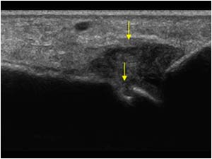 Synovial thickening of the second MTP joint and a small erosion