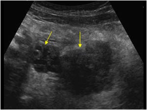 Mass lesion and a normal right ovary