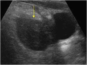 Hemorrhagic necrotic tordated ovarian cyst longitudinal