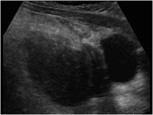 Hemorrhagic necrotic tordated ovarian cyst transverse