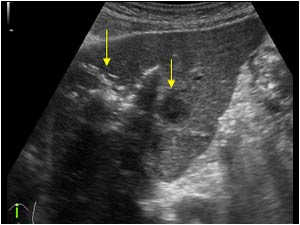 Liver abscess and air in the biliary tract