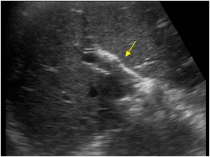 Air in the biliary tract