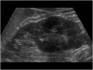 Duplex kidney with parenchymal loss in the upperpole