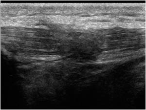 Patellar tendon rupture with scar tissue longitudinal