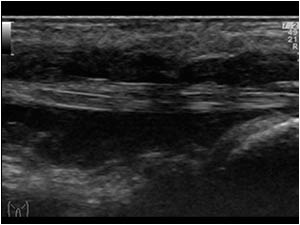 Tenosynovitis of the flexor digitorum tendon longitudinal