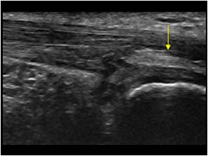Distal insertion tendinopathy with calcifications longitudinal
