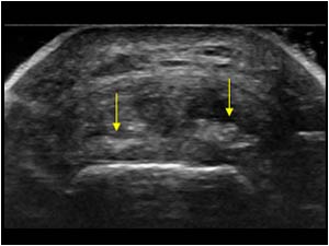 Distal insertion tendinopathy with calcifications transverse