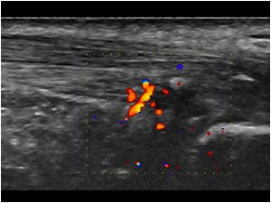 calcaneo-achilles conflict with neovascularity longitudinal