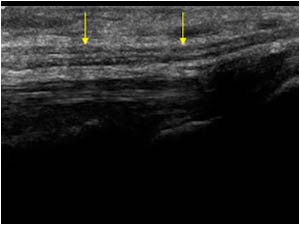 Tibial nerve in the proximal tibial tunnel longitudinal