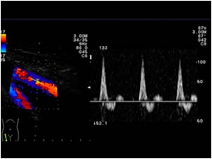 Normal velocity in the proximal superficial femoral artery (100 cm.)