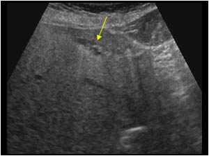 Localized area with dilatation of the intrahepatic bile ducts