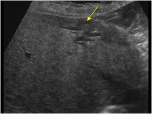 Localized area with dilatation of the intrahepatic bile ducts