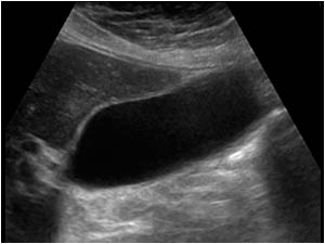 Gallbladder in supine position