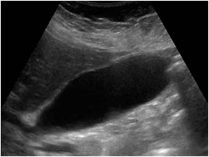 Gallbladder in supine position