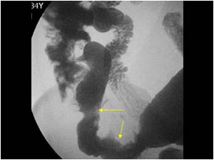 Abnormalities mimicking an acute appendicitis