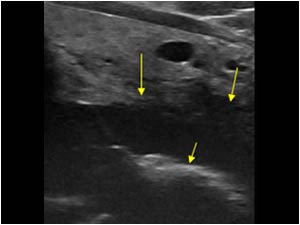Esophagus carcinoma dorsal to the thyroid gland with a central air configuration longitudinal