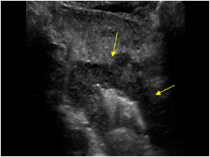 Esophagus carcinoma dorsal to the thyroid gland with a central air configuration longitudinal